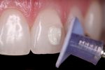 Shofu Direct Dia Diamond Polishing Paste - Image 5