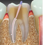 Dentsply Ah Plus Root Canal Sealant - Image 6