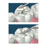 Plastic Filling Instrument - Image 3
