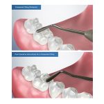 Plastic Filling Instrument - Image 4