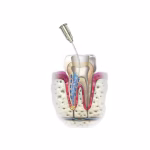 Maarc Endogel-RC 17% EDTA Gel - Image 2