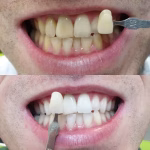 Maarc Blitz White Bleaching Kit - Image 3