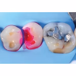 Maarc Find Fast Caries Indicator - Image 3