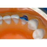 Maarc Inlay/Onlay Wax Sticks - Image 3