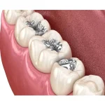 DPI Silver Amalgam Powder 15g - Image 4
